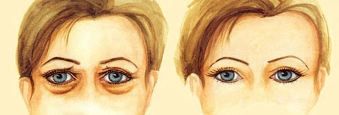 eyelid surgery abroad